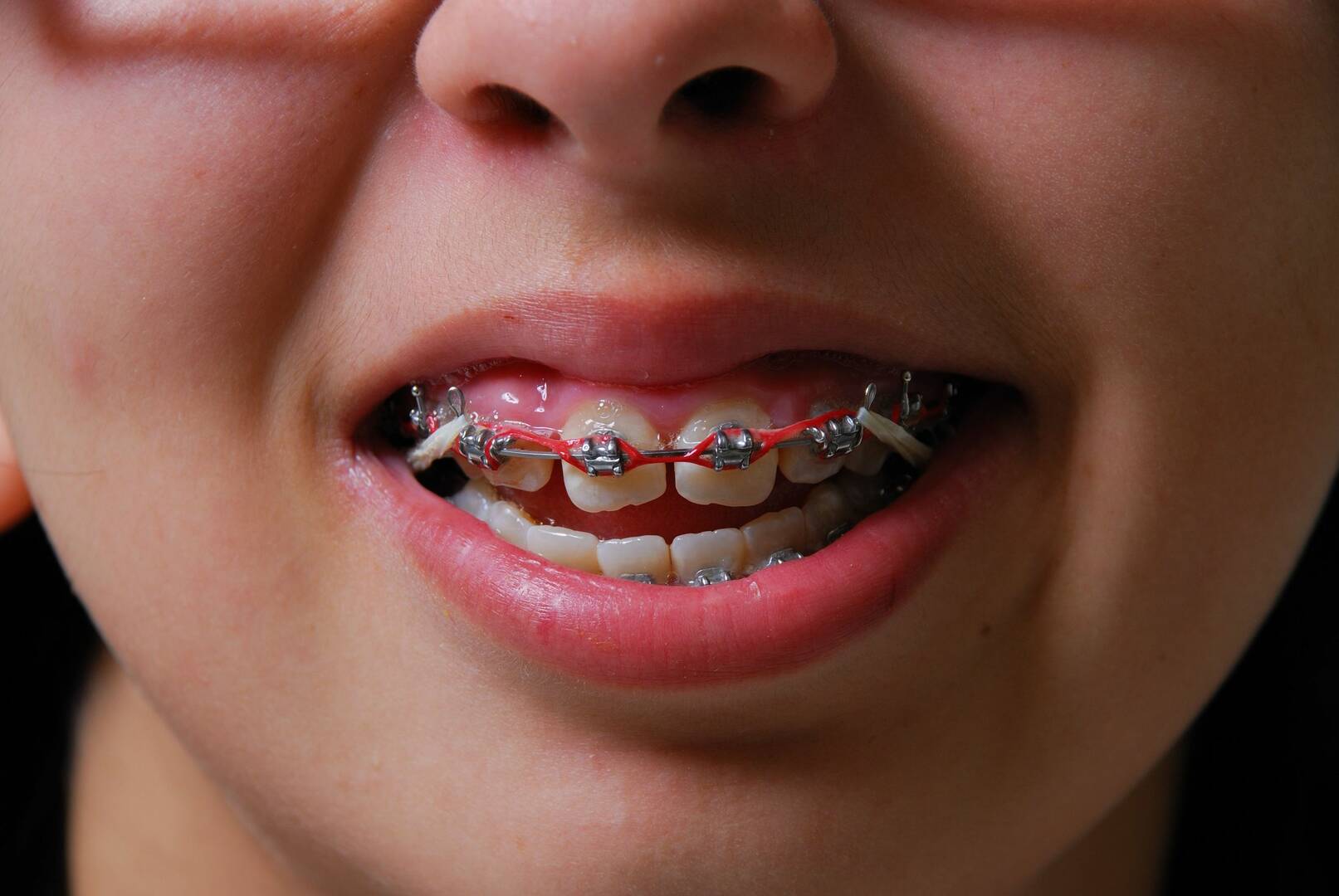 Sedation Services Dentist Kelowna